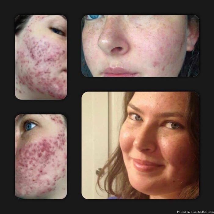 Finally Get rid off Acne, Psoriasis and Eczema