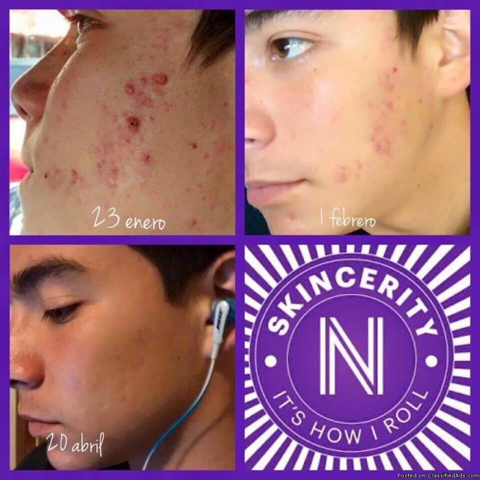 Finally Get rid off Acne, Psoriasis and Eczema, 1